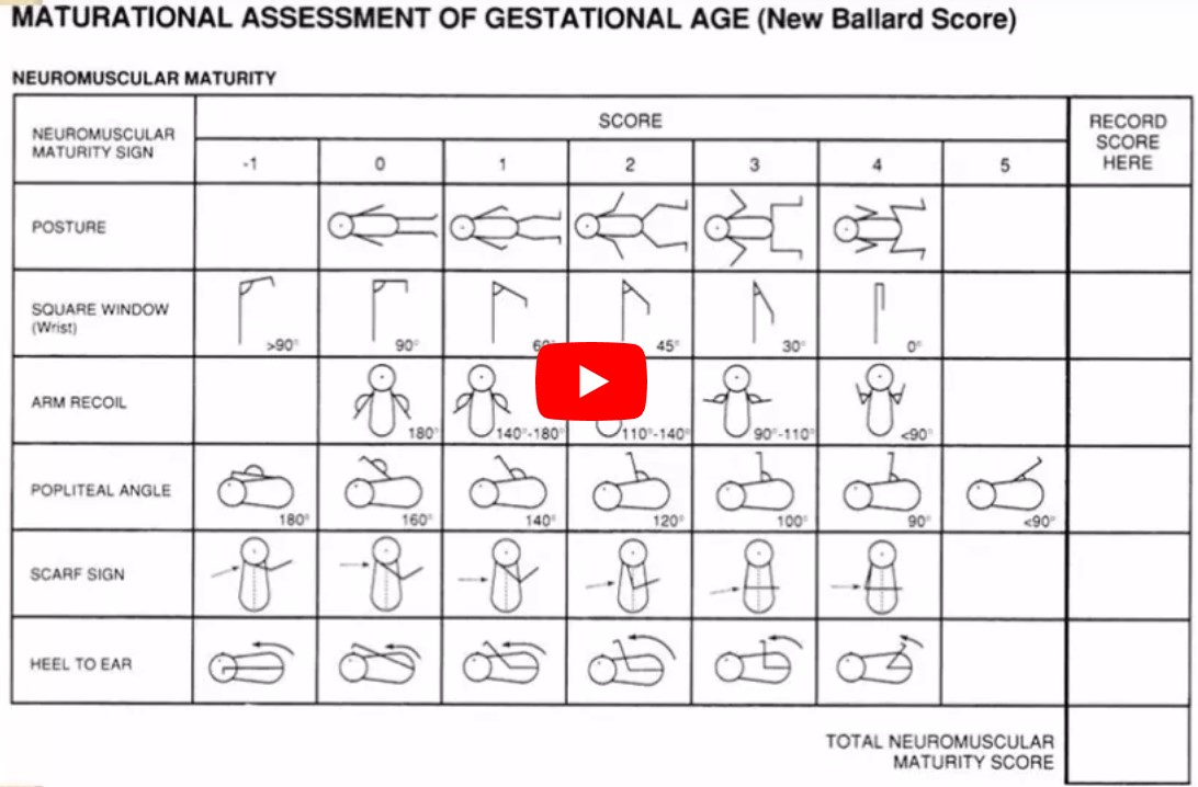 The Ballard Score Assessment of Gestational Age
