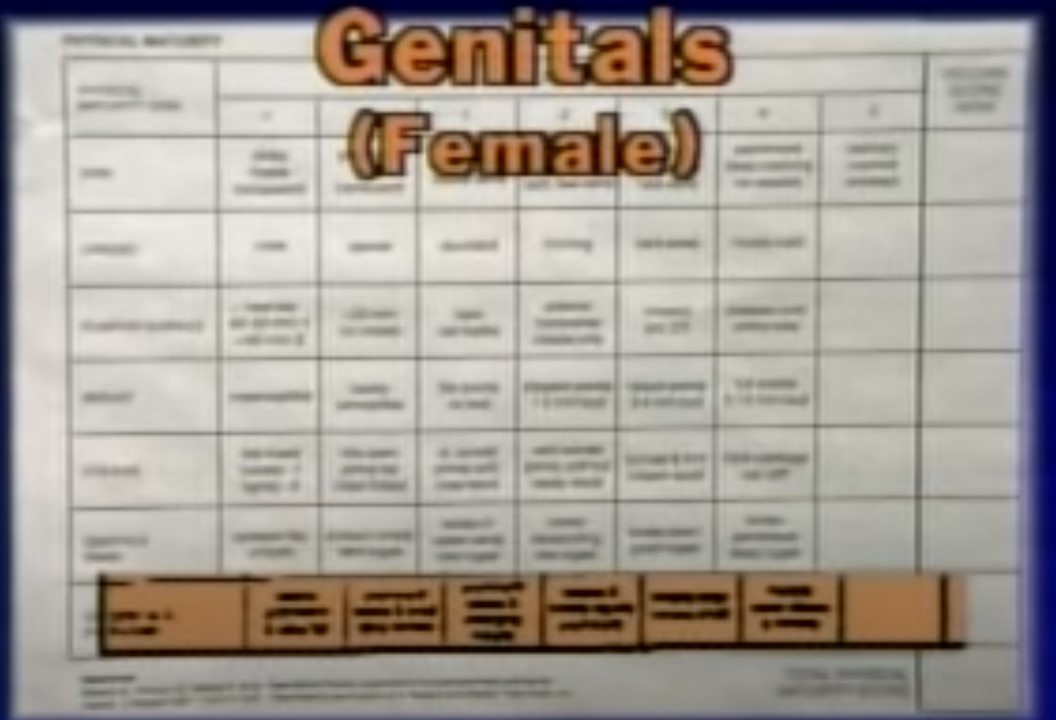 The Ballard Score Assessment of Gestational Age